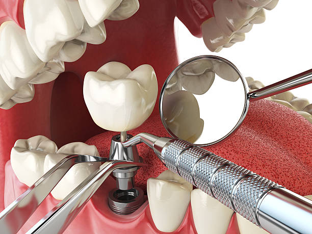 Best Broken or Chipped Tooth Repair in Selah, WA